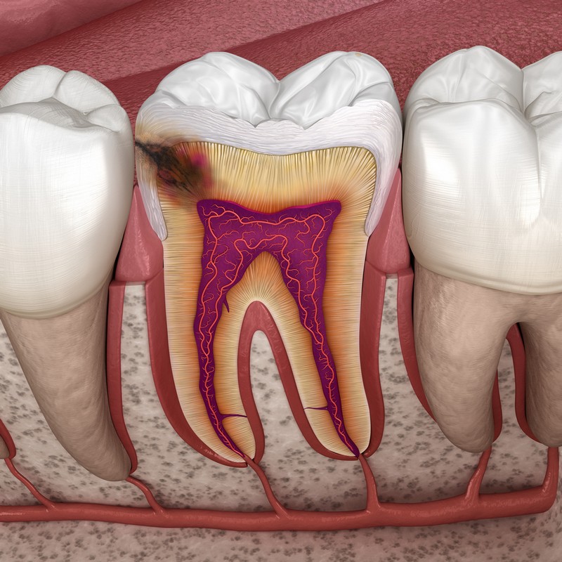 carii dentare constanta, tratament carii constanta, alya medical center constanta, stomatologie cons