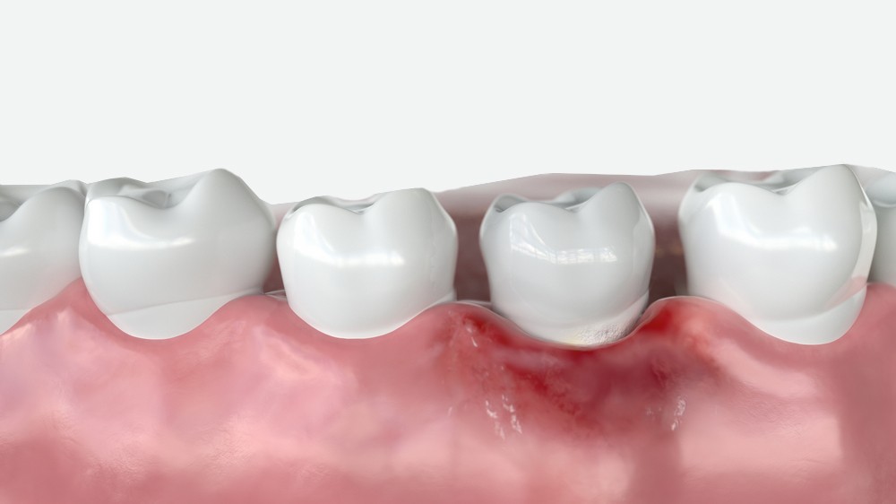parodontologie constanta, stomatologie constanta, dentist constanta, tratament parodontoza constanta