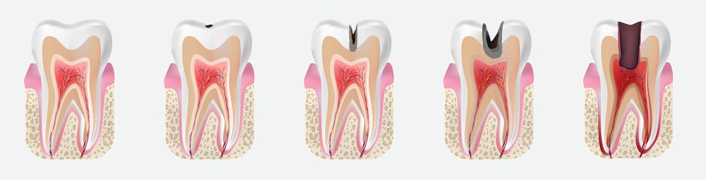 carii dentare constanta, tratament carii constanta, alya medical center constanta