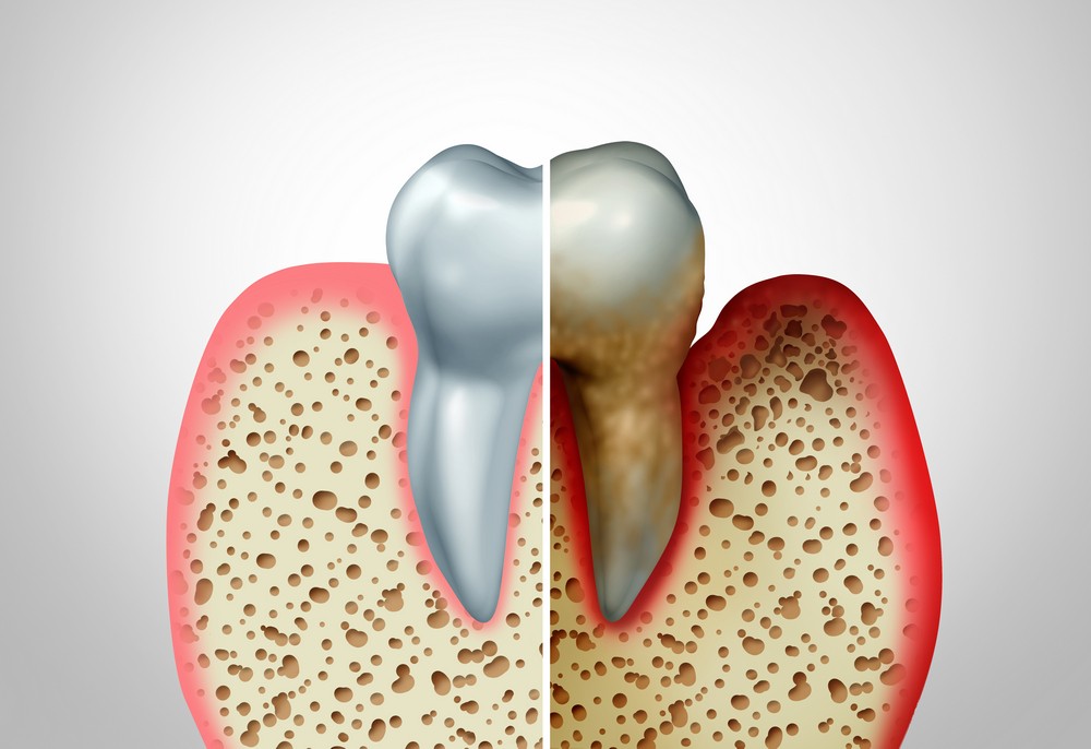 parodontologie constanta, stomatologie constanta, dentist constanta, tratament parodontoza constanta