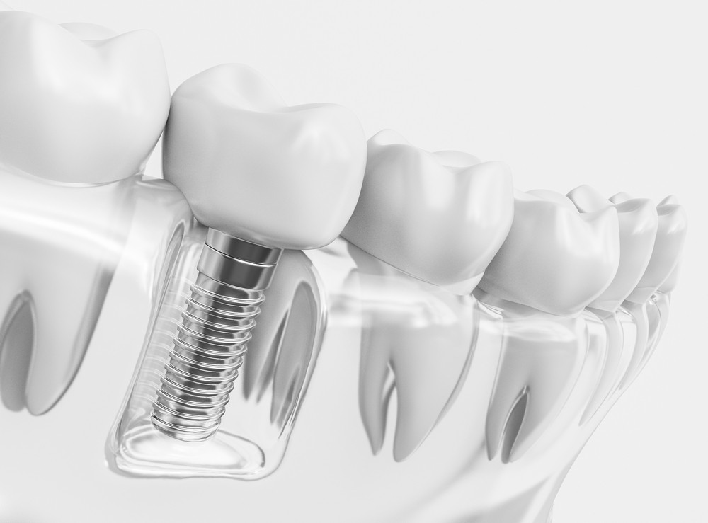 alya medical center, stomatologie constanta, implant dentar constanta, dentist constanta